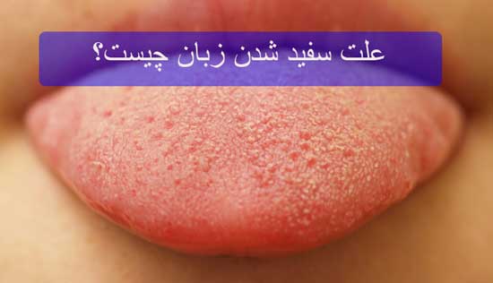 علت سفید شدن زبان چیست؟/دپوی