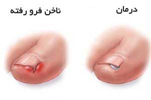 ناخن فرو رفته در گوشت انگشت را چگونه درمان کنیم؟ /دپوی عید