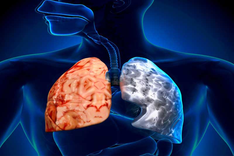 بیماری&zwnj;های مزمن تنفسی چه کسانی را درگیر می&zwnj;کند؟