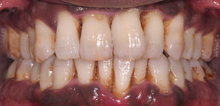 بزاق دهان چه تاثیری در جرم سازی دارد؟ بزاق دهان چه تاثیری در جرم سازی دارد؟