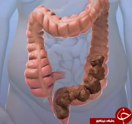 اگر دچار سندروم روده تحریک پذیر شدهاید، گوش به زنگ باشید + راه درمان یبوست اگر دچار سندروم روده تحریک پذیر شدهاید، گوش به زنگ باشید + راه درمان یبوست