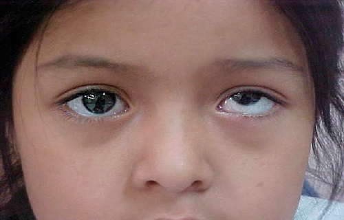 اصلاح نشدن عیوب انکساری چشم عامل انحراف چشم/عیوب انکساری را در کودکی درمان کنید