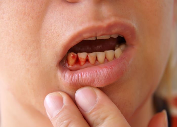 هرآنچه برای داشتن لثه&zwnj;هایی سالم لازم دارید