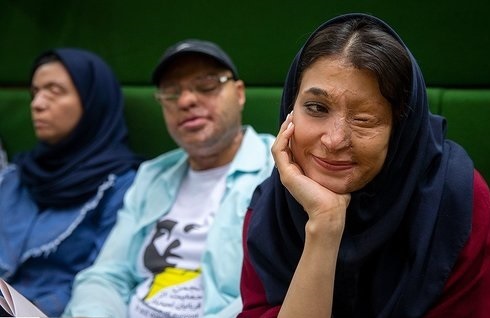 مجرمان اسیدپاشی به قصاص نفس یا عضو محکوم می&zwnj;شوند