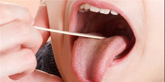 سنگ لوزه گریبانگیر چه کسانی می&zwnj;شود؟ +مهم&zwnj;ترین نشانه&zwnj;های ابتلا
