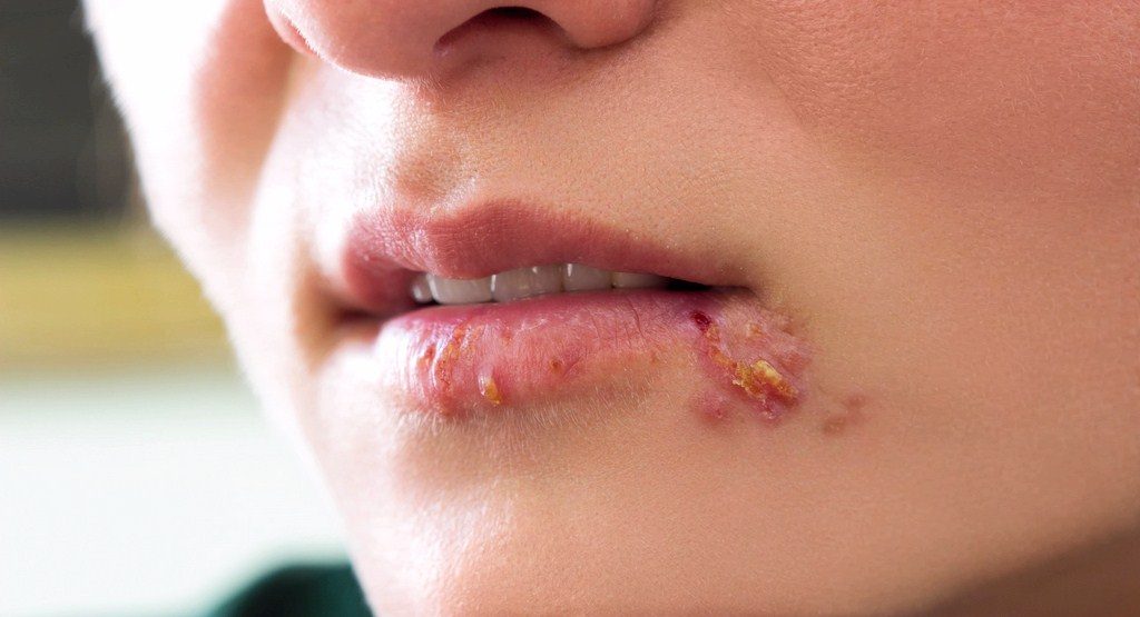 زخم&zwnj;های دردناکی که به جان پوست صورت می&zwnj;افتد/ زرد زخم چه کسانی را گرفتار می&zwnj;کند؟