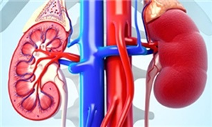 کم آبی بدن برای افراد مبتلا به سنگ کلیه خطرناک است