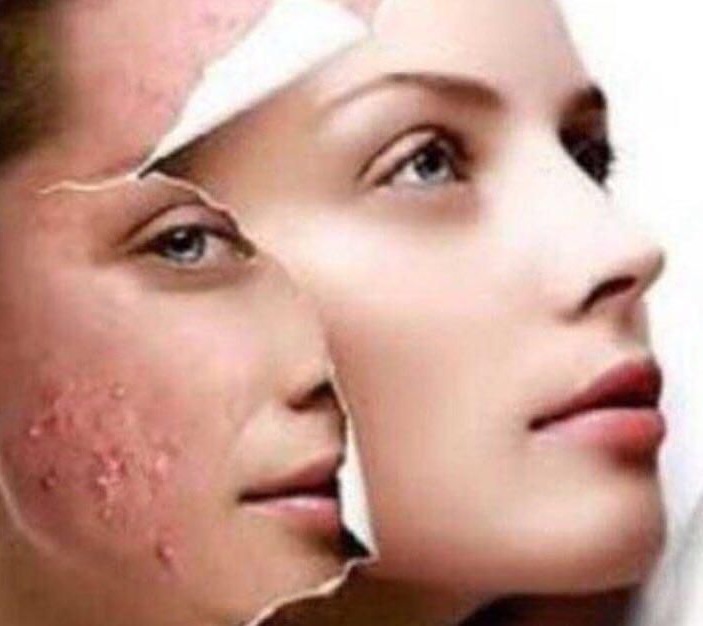 انگل&zwnj;های وحشتناکی که به جان پوستتان می&zwnj;افتد +راه&zwnj;های انتقال