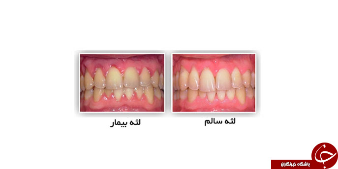 از روی شکل لثه&zwnj;ها چه بیماری&zwnj;هایی را میتوان تشخیص داد؟