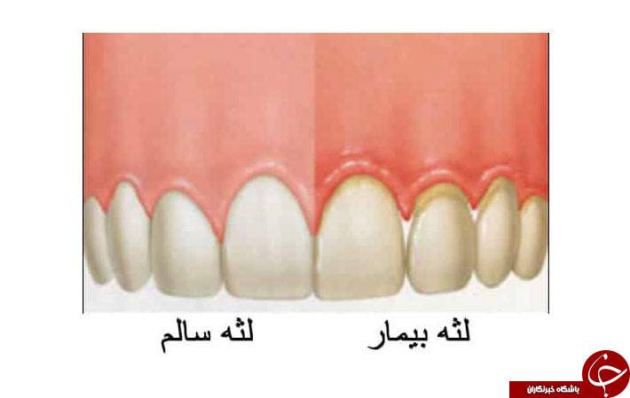 از روی شکل لثه&zwnj;ها چه بیماری&zwnj;هایی را میتوان تشخیص داد؟