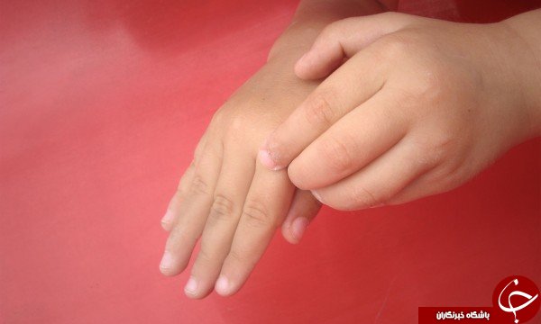 چرا گاهی خارش شدید به جانمان می&zwnj;افتد؟!