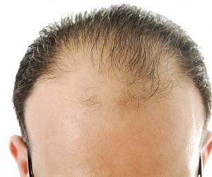چرا ریزش ارثی مو در تابستان بیشتر می&zwnj;شود؟