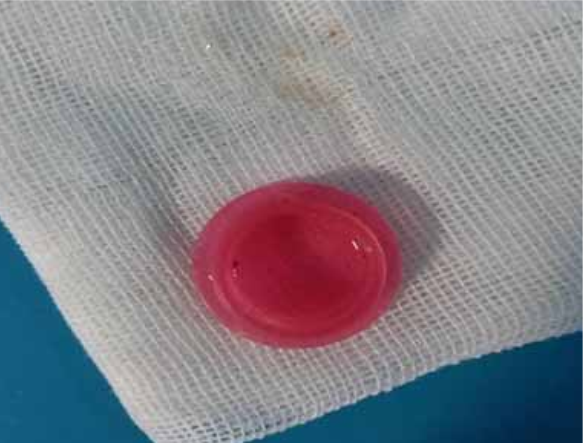 خارج کردن در قمقمه و هسته زردآلو از مری دو کودک
