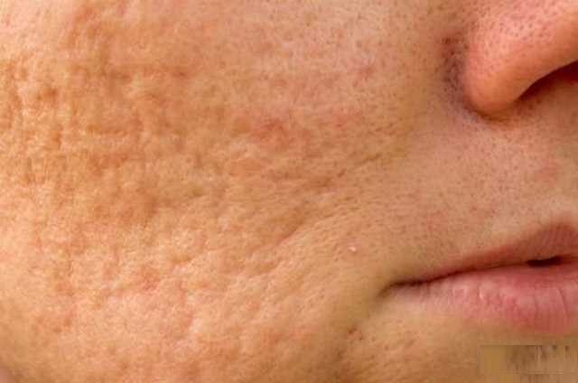 سلولیت خطرناک است؟ علائم و راه&zwnj;کار درمانی
