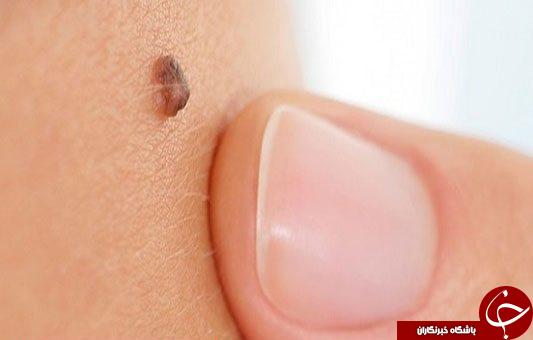 بررسی علل ایجاد خال گوشتی بر روی پوست +معرفی انواع آن بررسی علل ایجاد خال گوشتی بر روی پوست +معرفی انواع آن