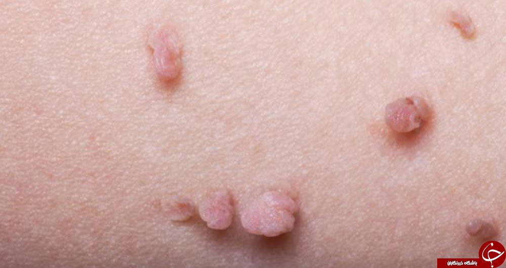 بررسی علل ایجاد خال گوشتی بر روی پوست +معرفی انواع آن بررسی علل ایجاد خال گوشتی بر روی پوست +معرفی انواع آن