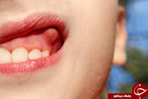 به آسانی از شر تورم و درد لثه خلاص شوید +درمان آبسه دندانی با چند فرمول طبیعی