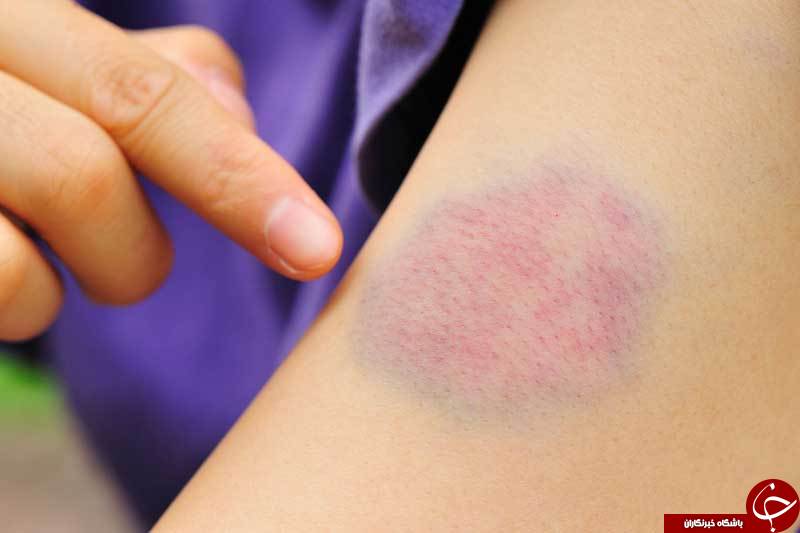 علت و نشانه&zwnj;های مهم ابتلا به سرطان مغز استخوان