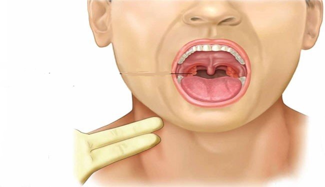 تب روماتیسم؛ بیماری خطرناکی که با یک گلودرد ساده شروع می&zwnj;شود + راه پیشگیری