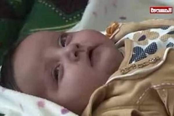 نوزادی که بخاطر محاصره فرودگاه یمن قربانی شد + تصاویر