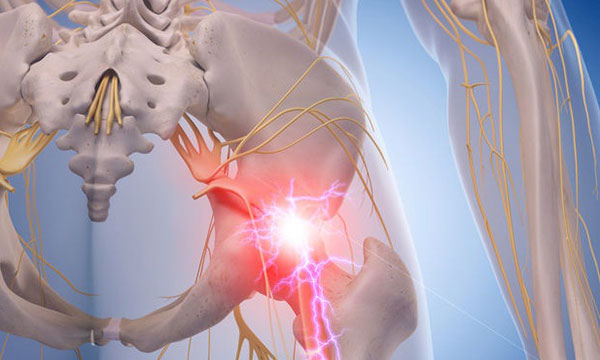درد سیاتیک چیست؟ + علت&zwnj;ها و درمان آن