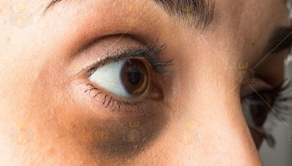 چگونه حلقه&zwnj;های تاریک دور چشم را درمان کنیم؟