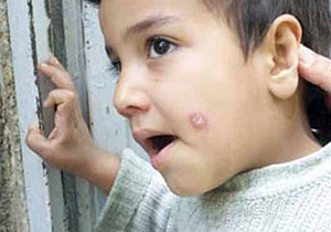 سالک ردپای همیشه ماندگار بر چهره