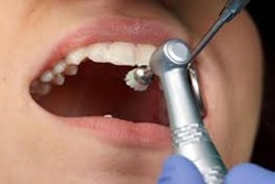 اجرای طرح دندان عاری از پوسیدگی ویژه دانش آموزان پایه هفتم