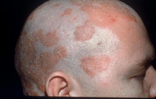 سبورئیک درماتایتیس/التهاب پوستی