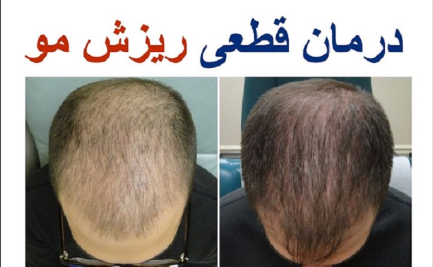 رفع معجزه آسای ریزش مو و درمان طاسی و رفع سفیدی مو&zwnj;ها دروغ است / مردم فریب نخورید