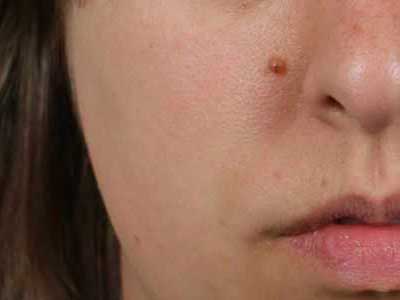 بررسی علل ایجاد خال گوشتی بر روی پوست +معرفی انواع آن بررسی علل ایجاد خال گوشتی بر روی پوست +معرفی انواع آن