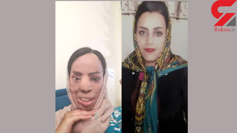 حبس و دیه برای عروس اسیدپاش + عکس دردناک