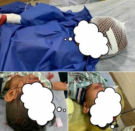 سگ هار پوست سر کودک ۷ ساله بندرعباسی را کند! + عکس