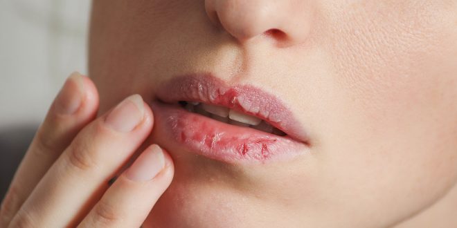 بهترین راهکارها برای چاقی صورت/آیا اضافه وزن در دوران بارداری خوب است/بهترین روش برای درمان خشکی لب/تفاوت میان سیاتیک و دیسک کمر/ بهترین راهکارها برای چاقی صورت/آیا اضافه وزن در دوران بارداری خوب است/بهترین روش برای درمان خشکی لب/تفاوت میان سیاتیک و دیسک کمر/