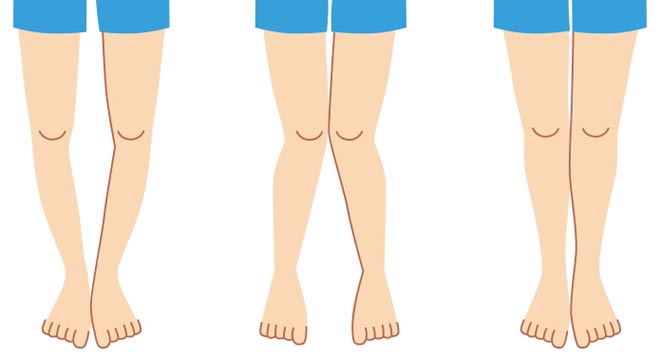 کم&zwnj;تحرکی ساختار قامتی دانش آموزان را هدف قرار می&zwnj;دهد / شایع&zwnj;ترین ناهنجاری&zwnj;های اسکلتی در نوجوانان