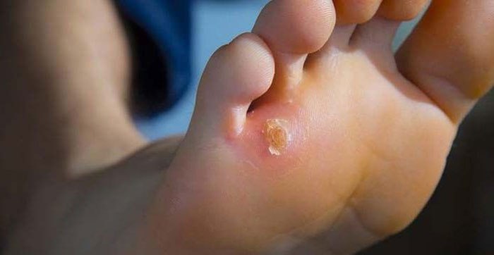 از بین بردن پینه پا