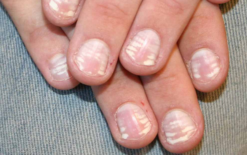 ساعت10/// بهترین موقع مصرف شیر چه زمانی است؟ /محل سوختگی را چگونه شست و شو دهیم/سلولیت چیست؟/پوسته پوسته شدن ناخن ها چه دلایلی دارد؟