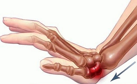 شکستگی کالیس در یک قدمی زنان است