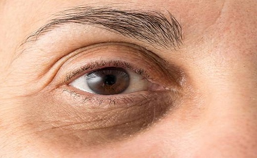 رهایی از تیرگی دور چشم و پُف زیر چشم با طب سنتی