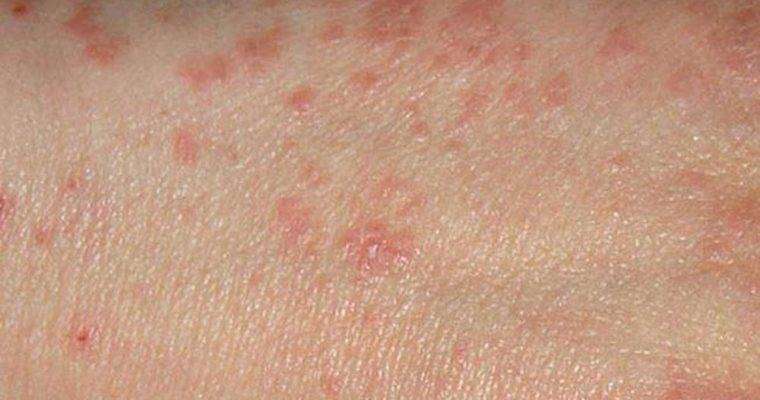 آیا جوش مسری است و از کسی به کسی دیگر منتقل می شود؟
