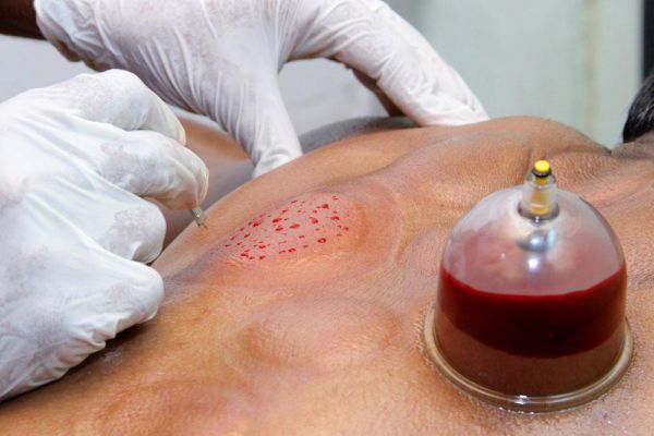 رفع تلخی دهان با طب سنتی