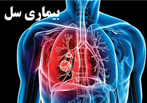 بیماری سل را بیشتر بشناسیم