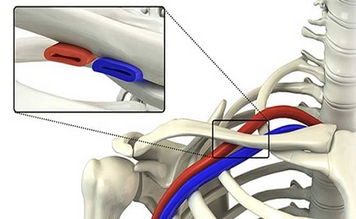 زنگ خطر سندروم خروجی قفسه سینه با دنده گردنی به صدا در می&zwnj;آید