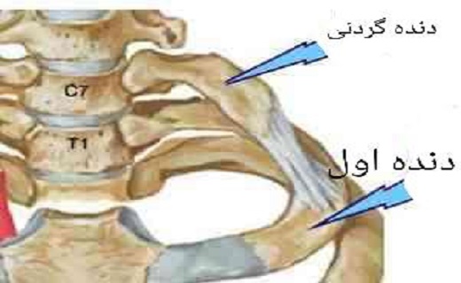 زنگ خطر سندروم خروجی قفسه سینه با دنده گردنی به صدا در می&zwnj;آید