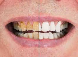 فرمول های ساده برای جلوگیری از پوسیدگی دندان +غذاهای مضر برای سلامت دندان