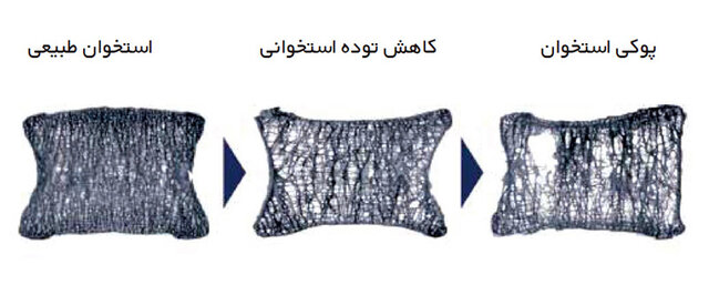 وقتی یک عطسه می&zwnj;تواند استخوان&zwnj;هایتان را بشکند!//گلی