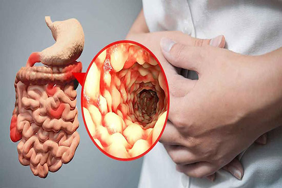 آرتریت پسوریاتیک چیست؟ علائم آن را بشناسید///صادقی