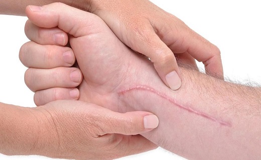 چگونه با ورزش زخم&zwnj;های خود را سریع&zwnj;تر ترمیم کنیم؟