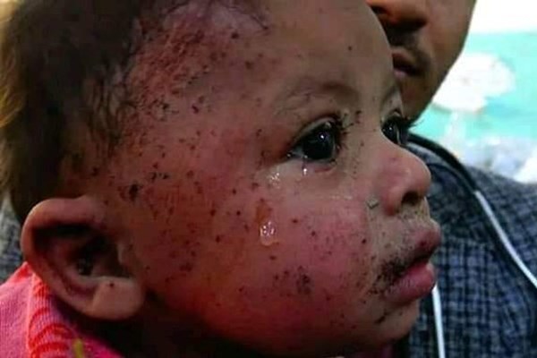 &laquo;حلیمه&raquo;؛ نوزادی که حملات متجاوزان سعودی باعث شد طعم تلخ بی&zwnj;مادری را تجربه کند + تصاویر