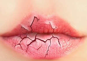 رفع ترک لب با طب سنتی رفع ترک لب با طب سنتی
